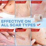 Wifamy Silicone Scar Sheets for Women: Medical Grade Scar Removal C-Section Recovery & Post-Surgery Care (1.6"X 120" Roll-3M) - Image 7