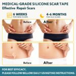 Silicone Scar Sheets, Silicone Scar Tape for Surgical Scars - 60" x 1.6" Roll - 1.5M, Medical Grade Reusable Effective Scar Removal for Keloid, C-Section, Tummy Tuck, and Acne - Image 4