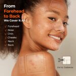 TKTK Pimple Patches for Face, 6 Sizes Hydrocolloid Acne Patch Variety, Large Acne Stickers for Cheeks, Forehead, Chin, Nose, Back Blemishes Zit Breakouts (4 Shapes 356 Count) - Image 5