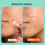 TKTK Pimple Patches for Face, 6 Sizes Hydrocolloid Acne Patch Variety, Large Acne Stickers for Cheeks, Forehead, Chin, Nose, Back Blemishes Zit Breakouts (4 Shapes 356 Count) - Image 7