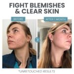 Vitamin C Serum for Face with Retinol & Salicylic Acid – Skin Clearing Acne Spot Treatment with Niacinamide, Hyaluronic Acid, MSM – Anti-Aging Facial Serum for Dark Spots and Blemishes - Image 5