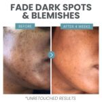 Vitamin C Serum for Face with Retinol & Salicylic Acid – Skin Clearing Acne Spot Treatment with Niacinamide, Hyaluronic Acid, MSM – Anti-Aging Facial Serum for Dark Spots and Blemishes - Image 7