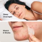 TKTK Hydrocolloid Bandages, 45 x 45 mm Large Pimple Patches for Face, XL Acne Patches for Body, Back, Forehead, Cheek Zit Breakouts, Big Hydrocolloid Patch (Square, Strip, Dot 5 Sizes 120 Count) - Image 5